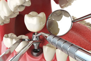 Illustration of dental implant