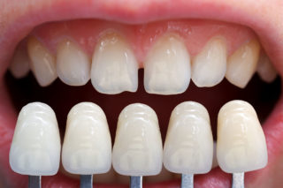 Porcelain veneers