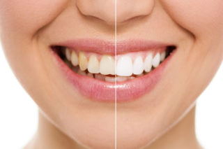 Before and after restorative dental procedure