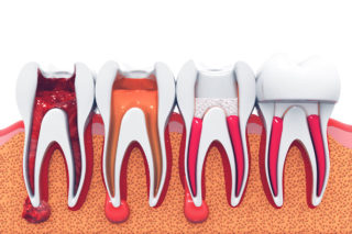 Various stages of root canal