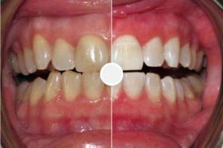 Before and after teeth whitening